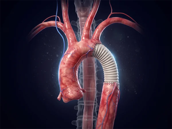 Aortic Surgery